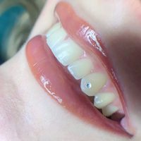 strass-dentaire-institut-sandrine-breuville